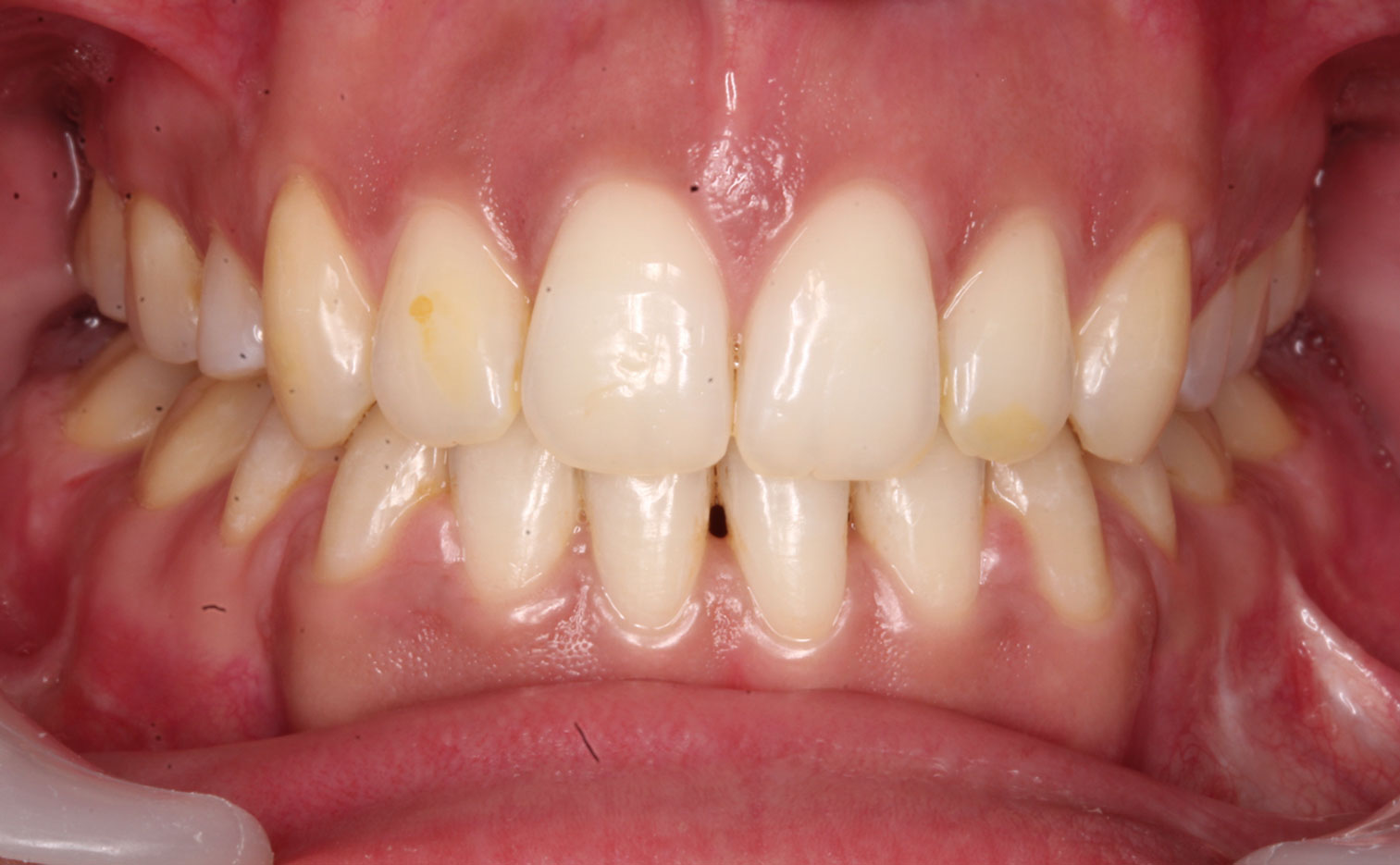 After image