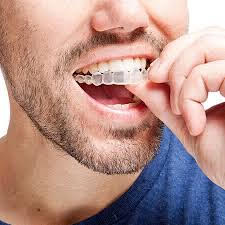Jeune homme qui met une gouttière invisalign