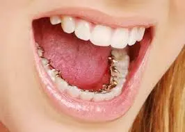 Une adolescente montre son appareil dentaire invisible, dissimulé derrière ses dents